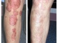 arogyam-pure-herbs-kit-for-psoriasis-small-0